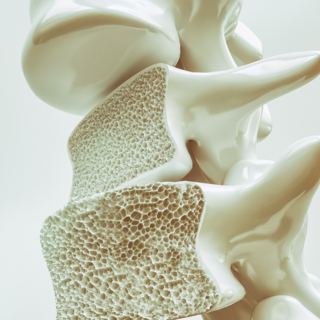 Osteoporosis Prevention and Management