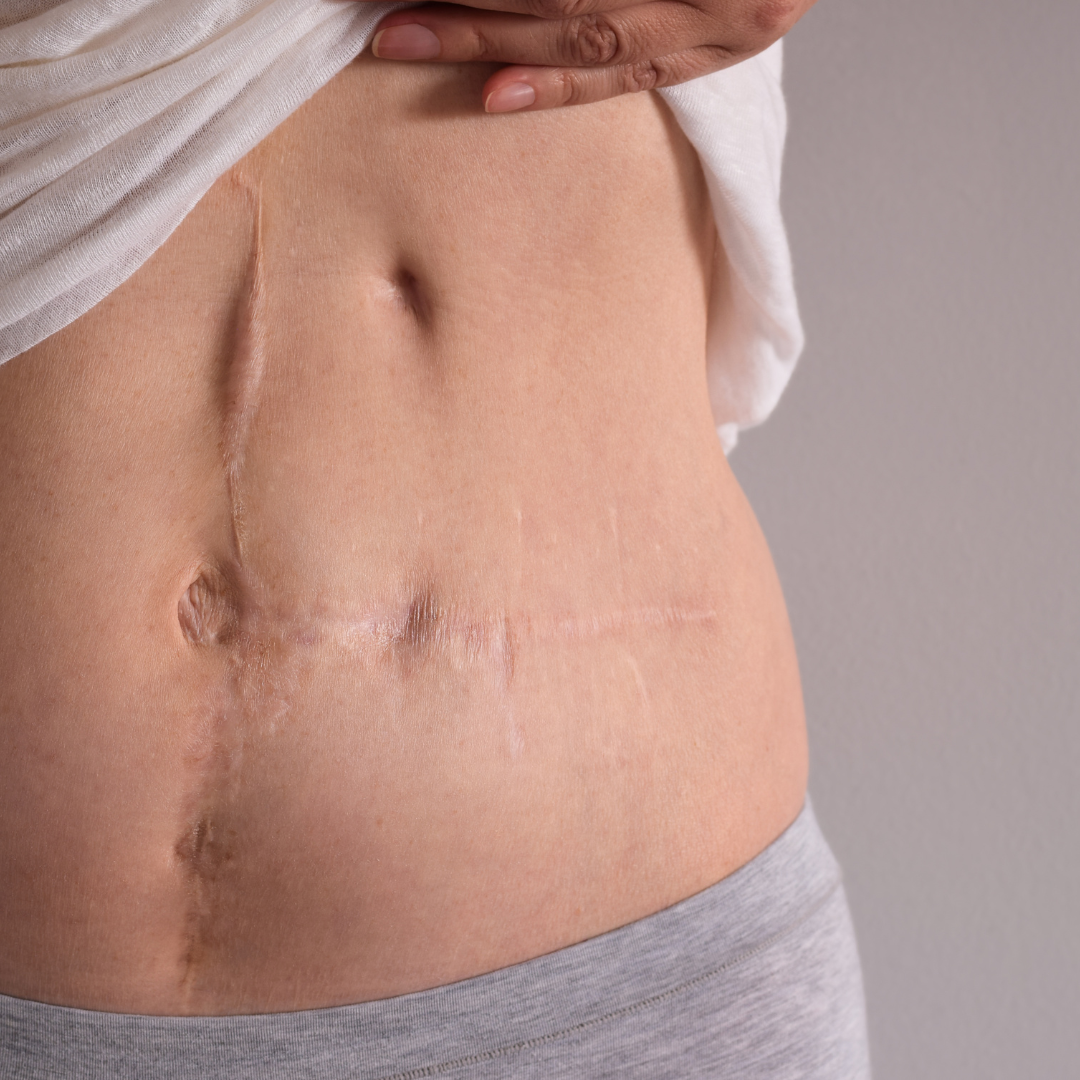 Total Laparoscopic Hysterectomy
